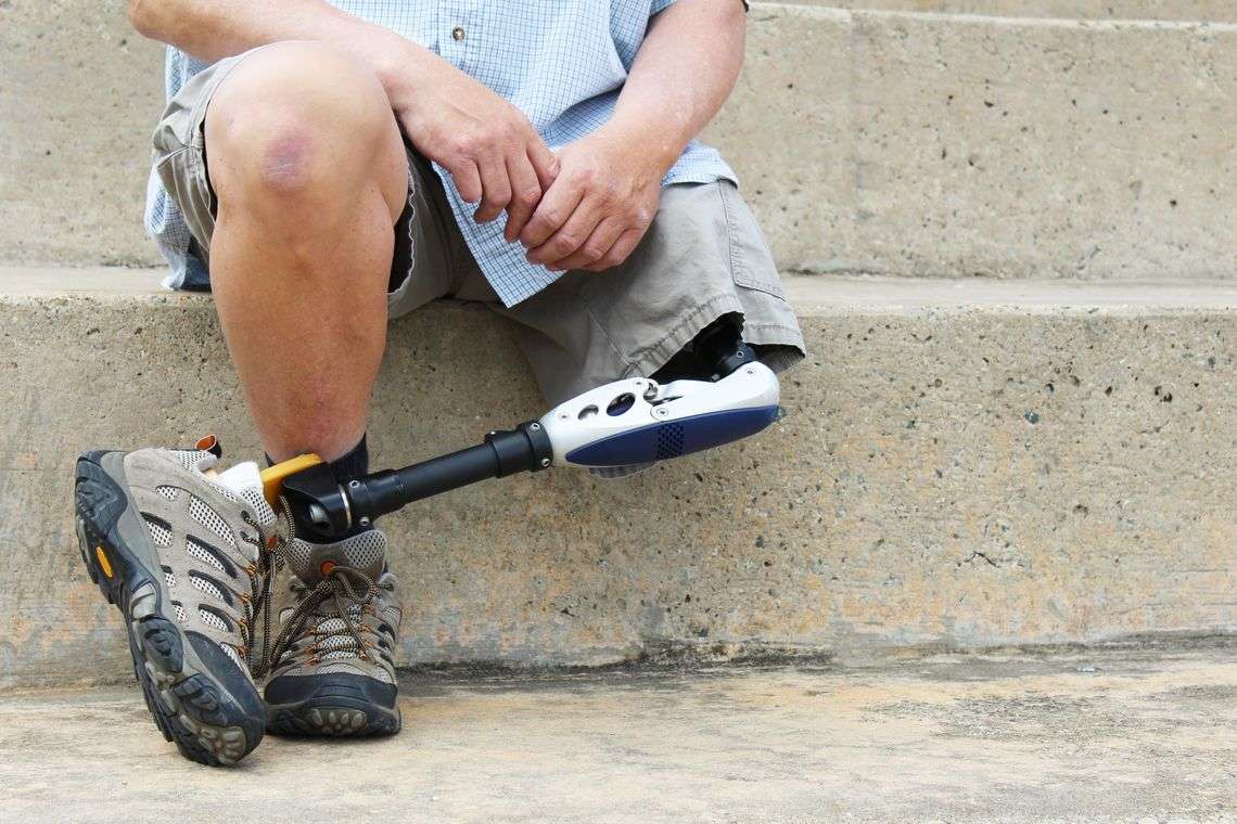 loss-limb-amputation-photo